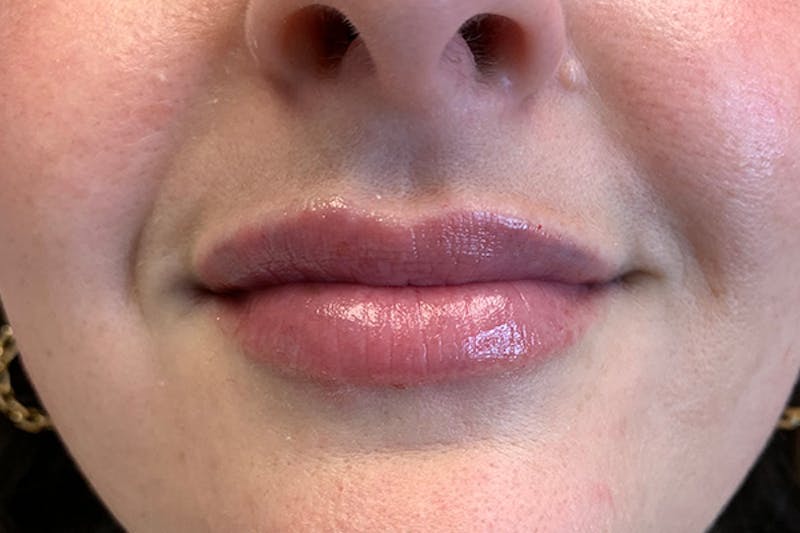 Lip Filler Before & After Gallery - Patient 220816 - Image 2