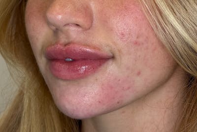 Facial Filler Before & After Gallery - Patient 324708 - Image 2