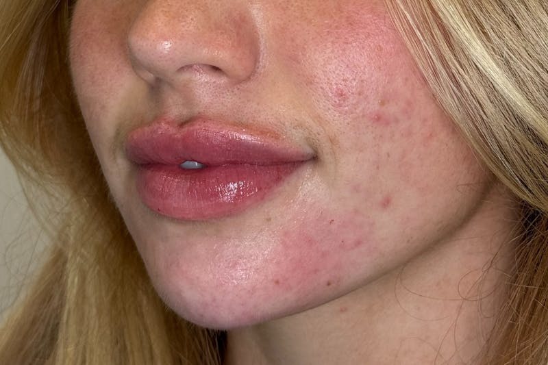 Facial Filler Before & After Gallery - Patient 324708 - Image 2