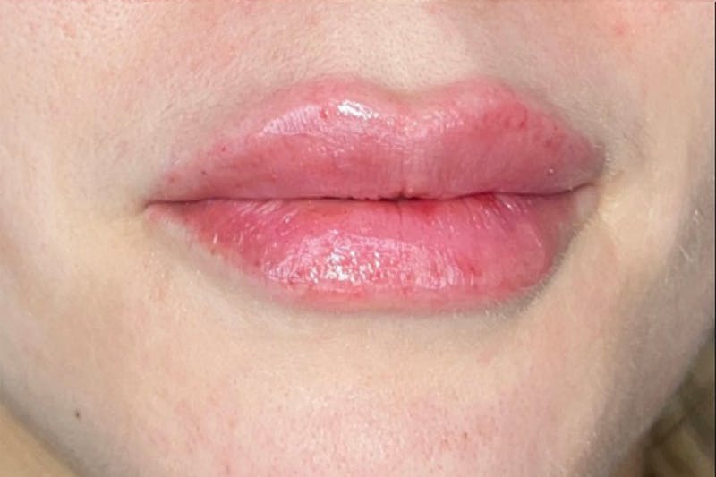 Lip Filler Before & After Gallery - Patient 383343 - Image 4