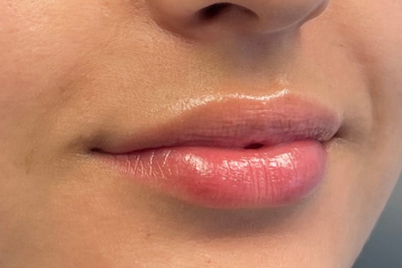Lip Filler Before & After Gallery - Patient 117693 - Image 3