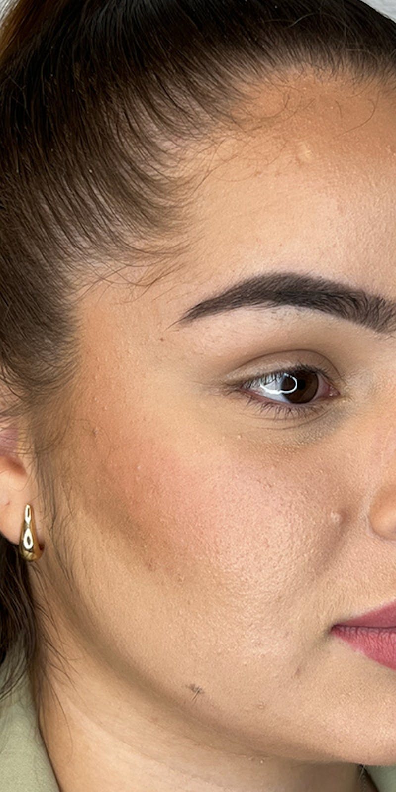 Nasolabial Fold Filler Before & After Gallery - Patient 221938 - Image 1