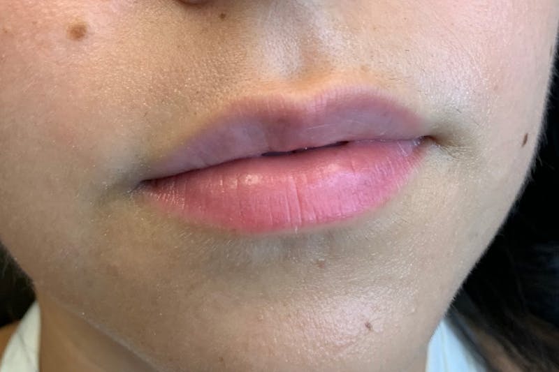 Lip Filler Before & After Gallery - Patient 240077 - Image 1