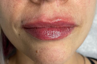 Lip Filler Before & After Gallery - Patient 317019 - Image 2
