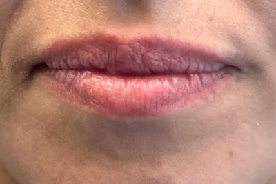 Lip Filler Before & After Gallery - Patient 242971 - Image 1