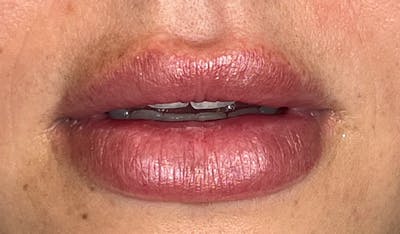 Lip Filler Before & After Gallery - Patient 314875 - Image 1