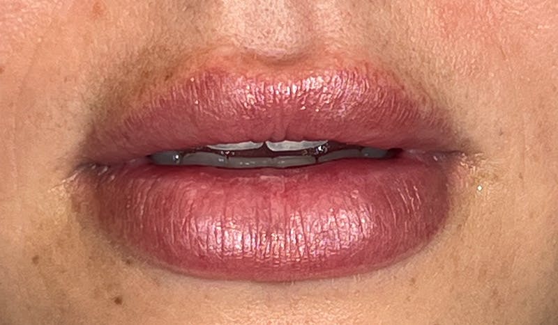 Lip Filler Before & After Gallery - Patient 314875 - Image 1