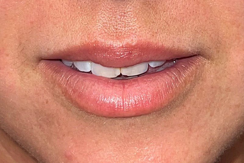 Lip Filler Before & After Gallery - Patient 367668 - Image 1