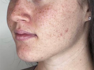 Facial Filler Before & After Gallery - Patient 331601 - Image 1
