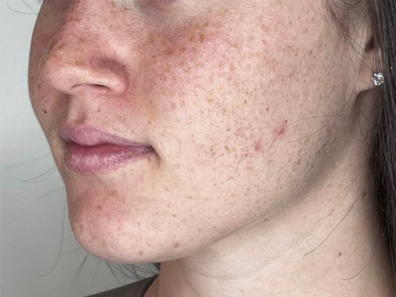 Facial Filler Before & After Gallery - Patient 331601 - Image 1