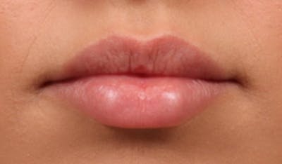 Lip Filler Before & After Gallery - Patient 395612 - Image 1
