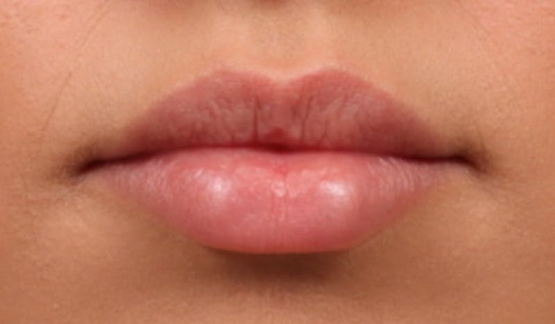 Lip Filler Before & After Gallery - Patient 395612 - Image 1