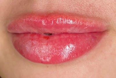 Lip Filler Before & After Gallery - Patient 113415 - Image 2