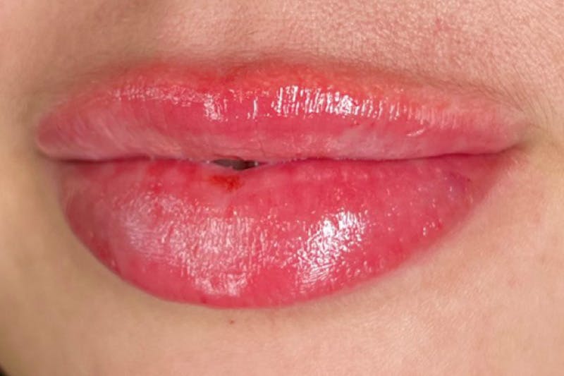 Lip Filler Before & After Gallery - Patient 113415 - Image 2
