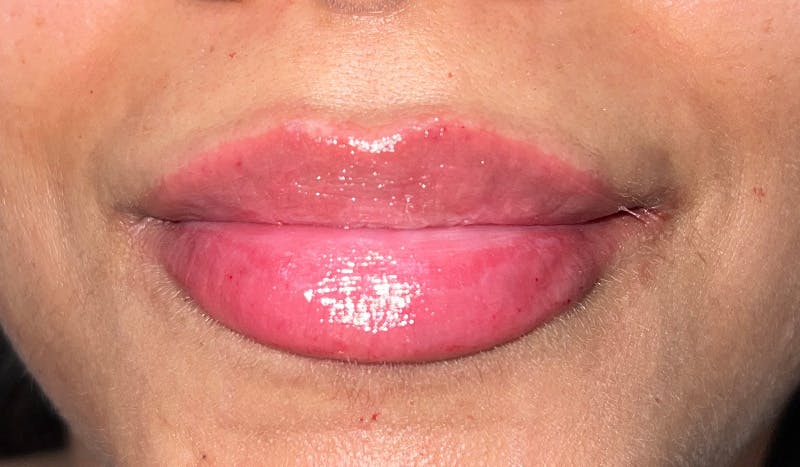 Lip Filler Before & After Gallery - Patient 309118 - Image 2