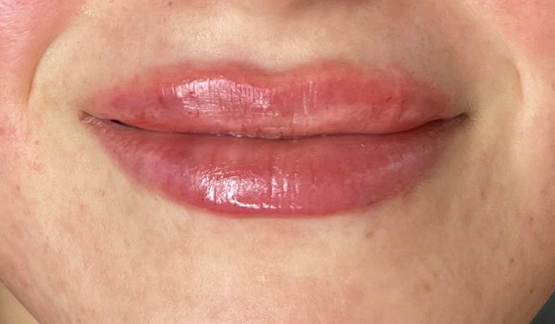 Lip Filler Before & After Gallery - Patient 277608 - Image 2