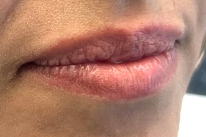 Lip Filler Before & After Gallery - Patient 242971 - Image 3