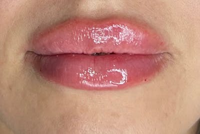 Lip Filler Before & After Gallery - Patient 242971 - Image 2