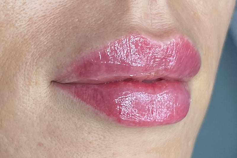 Lip Filler Before & After Gallery - Patient 364057 - Image 4