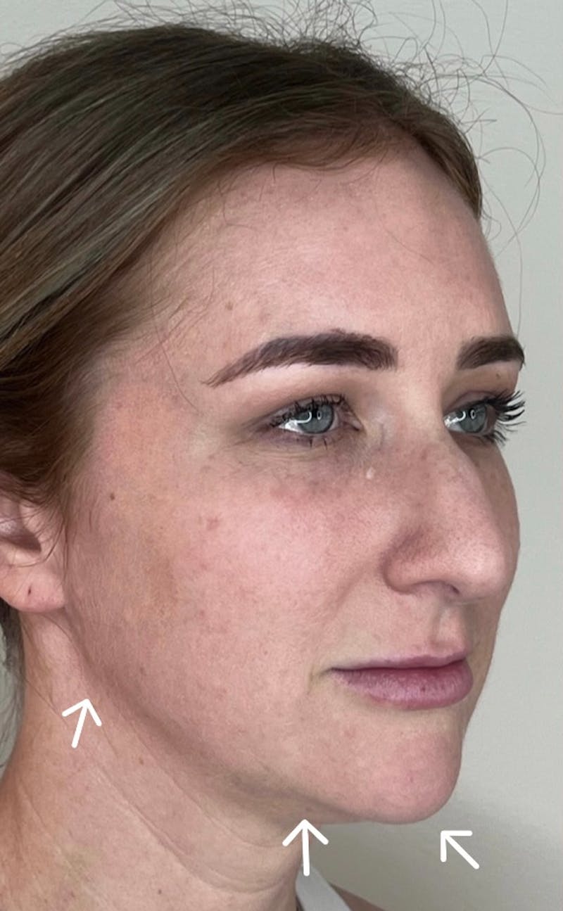 Facial Filler Before & After Gallery - Patient 602048 - Image 5