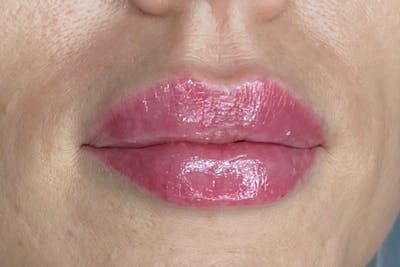 Lip Filler Before & After Gallery - Patient 364057 - Image 2