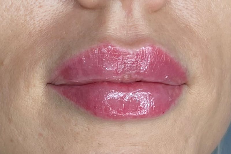 Lip Filler Before & After Gallery - Patient 364057 - Image 2