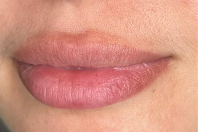 Lip Filler Before & After Gallery - Patient 313328 - Image 1