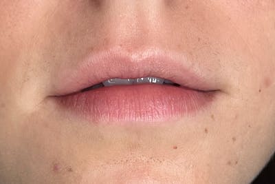 Lip Filler Before & After Gallery - Patient 216582 - Image 1