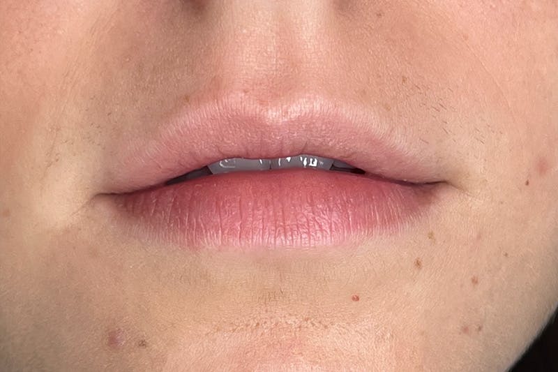 Lip Filler Before & After Gallery - Patient 216582 - Image 1