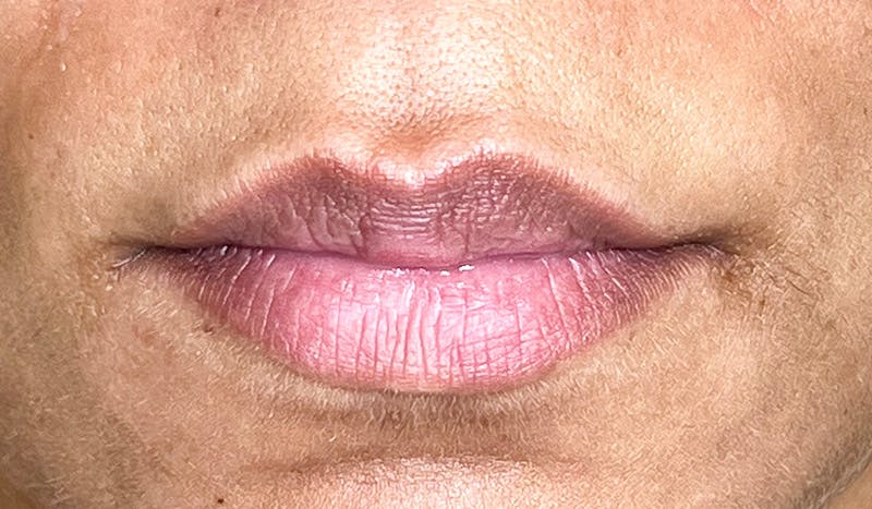 Lip Filler Before & After Gallery - Patient 309118 - Image 1