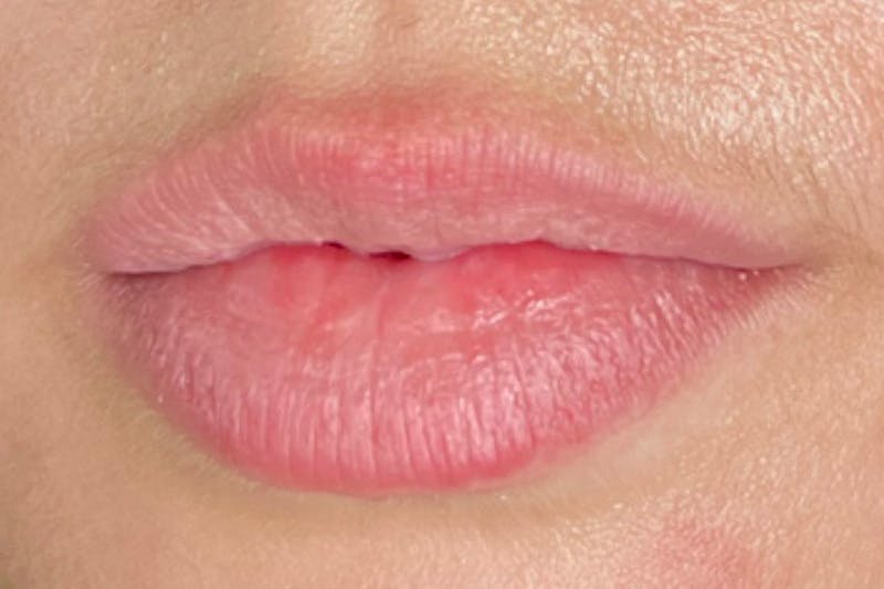 Lip Filler Before & After Gallery - Patient 113415 - Image 1
