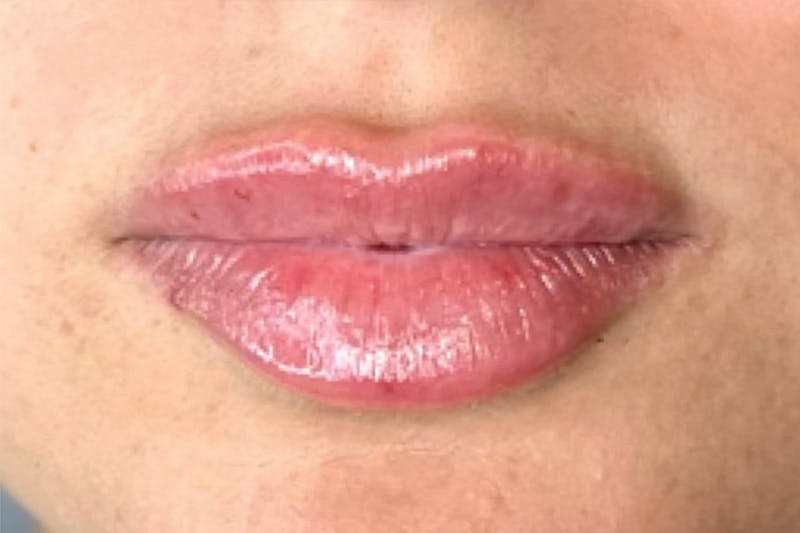 Lip Filler Before & After Gallery - Patient 118787 - Image 2