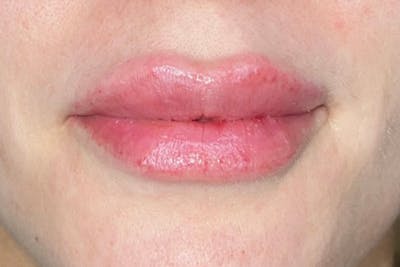 Lip Filler Before & After Gallery - Patient 383343 - Image 2