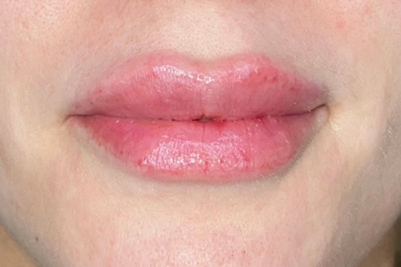 Lip Filler Before & After Gallery - Patient 383343 - Image 2