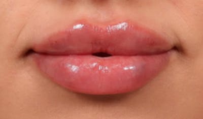 Lip Filler Before & After Gallery - Patient 395612 - Image 2