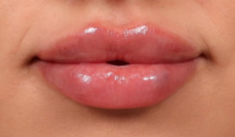 Lip Filler Before & After Gallery - Patient 395612 - Image 2
