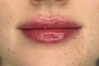 Lip Filler Before & After Gallery - Patient 229260 - Image 2