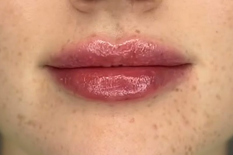 Lip Filler Before & After Gallery - Patient 229260 - Image 2