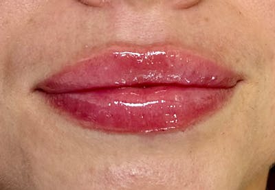 Lip Filler Before & After Gallery - Patient 435849 - Image 2
