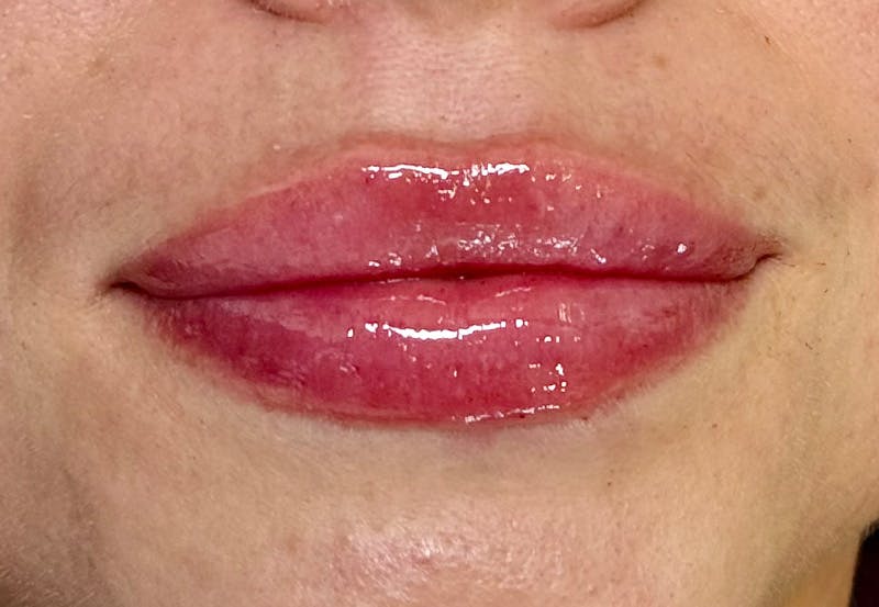 Lip Filler Before & After Gallery - Patient 435849 - Image 2