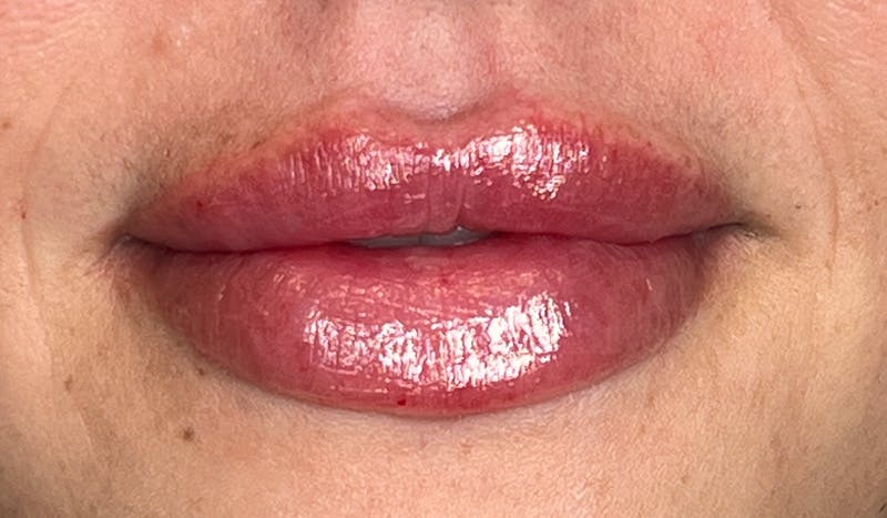 Lip Filler Before & After Gallery - Patient 314875 - Image 2