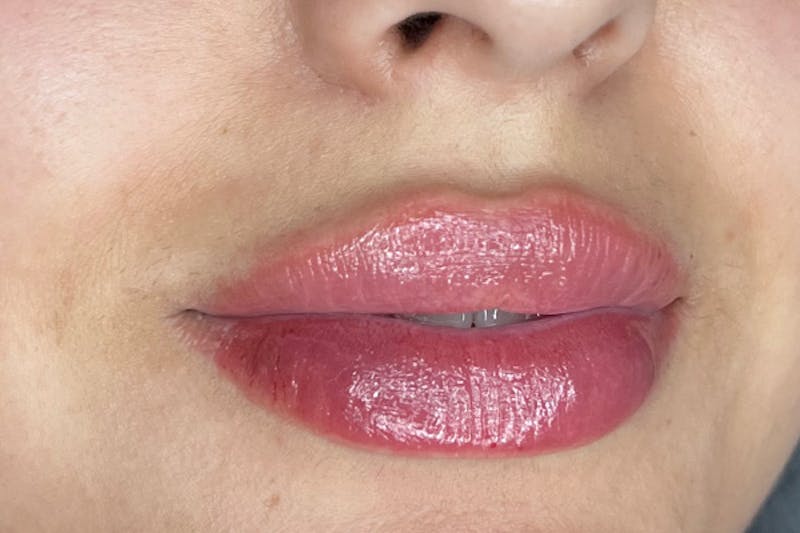 Lip Filler Before & After Gallery - Patient 117693 - Image 4