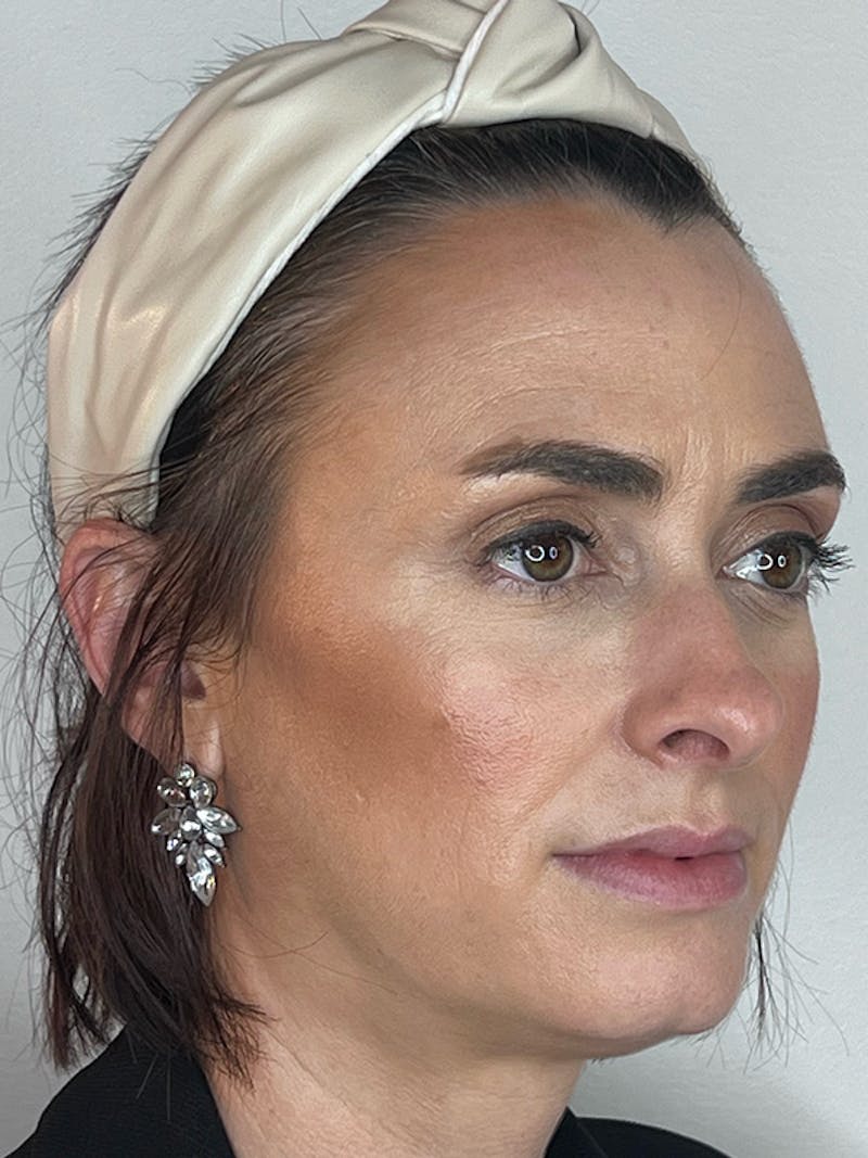 Facial Filler Before & After Gallery - Patient 370702 - Image 3