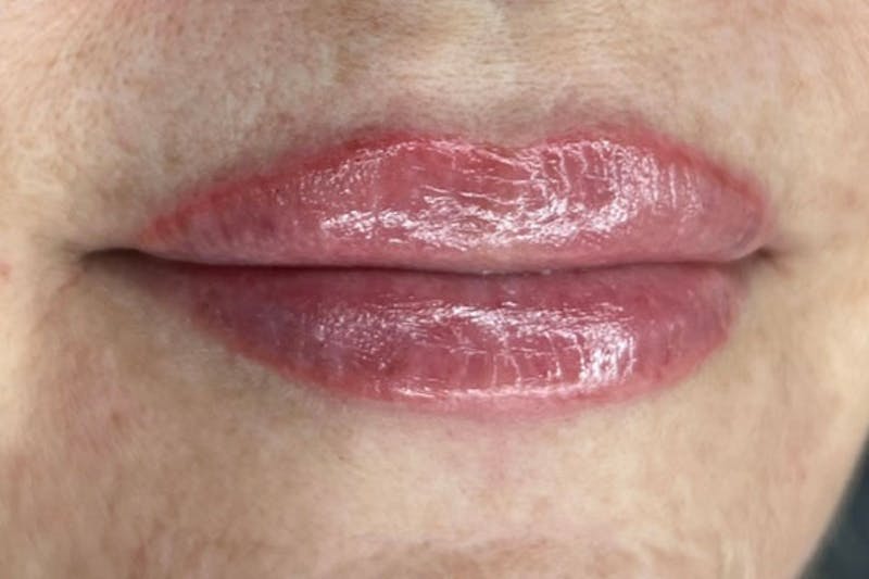Lip Filler Before & After Gallery - Patient 406528 - Image 2