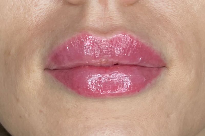 Lip Filler Before & After Gallery - Patient 364057 - Image 6