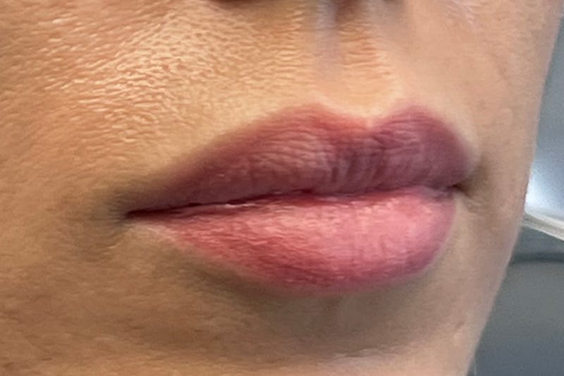 Lip Filler Before & After Gallery - Patient 364057 - Image 3