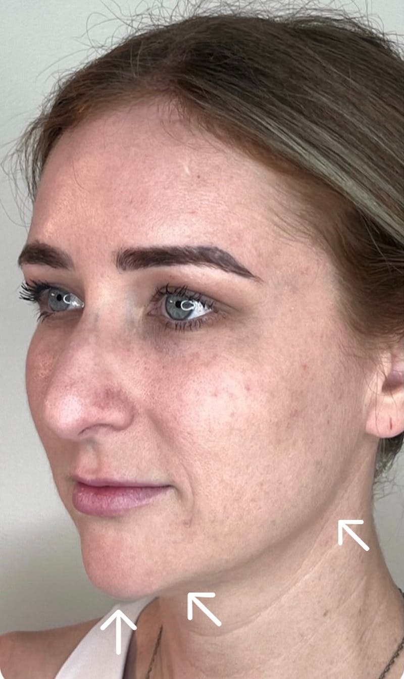 Facial Filler Before & After Gallery - Patient 602048 - Image 3