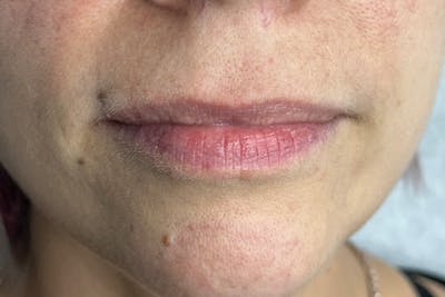 Lip Filler Before & After Gallery - Patient 317019 - Image 1