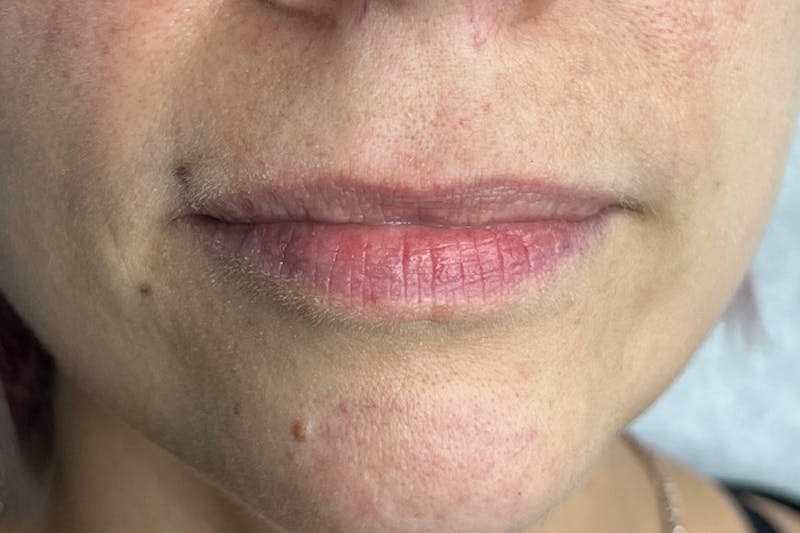 Lip Filler Before & After Gallery - Patient 317019 - Image 1