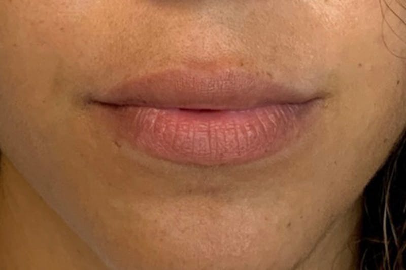 Lip Filler Before & After Gallery - Patient 170723 - Image 1